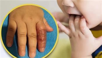 بسبب نصيحة على الانترنت.. صينية كادت أن تبتر إصبع رضيعتها