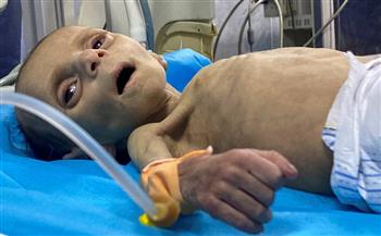 يونيسف: 13 ألف طفل في غزة دخلوا دائرة سوء التغذية الحاد خلال يوليو الماضي
