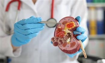 طرق سريعة للتخلص من حصوات الكلى