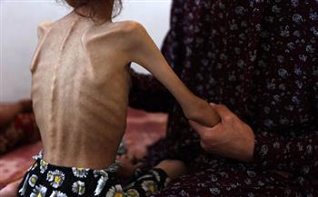 7 وفيات بسبب سوء التغذية والمجاعة في غزة خلال الساعات الـ24 الماضية