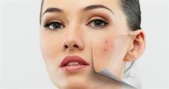 4  نصائح للتعامل مع حب الشباب