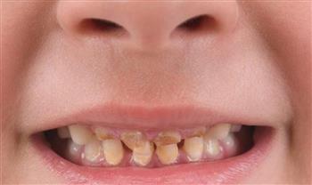 للأمهات.. أسباب تصبغ أسنان الطفل وطرق علاجه