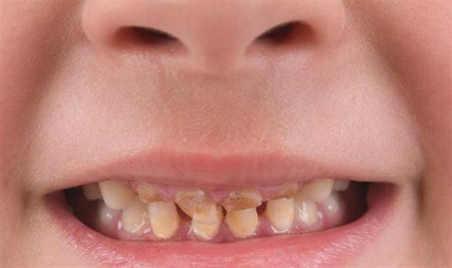 للأمهات.. أسباب تصبغ أسنان الطفل وطرق علاجه