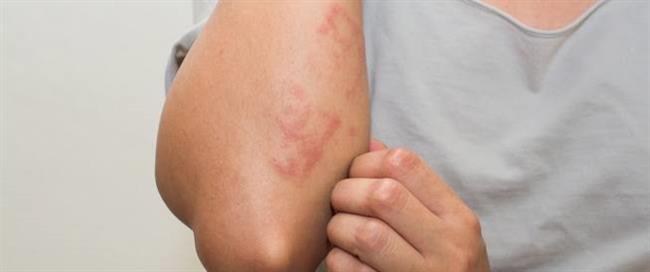 انتبه.. تلك الأعراض تظهر عند تعرضك لمسببات الحساسية 