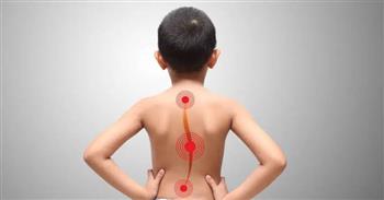 تشوهات العمود الفقري .. نصائح للوقاية