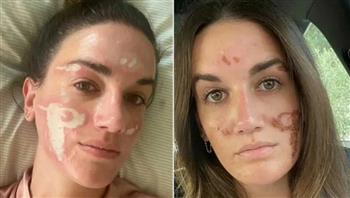 خبيرة تجميل شهيرة تشوه وجه فتاة مقابل 90  ألف دولار