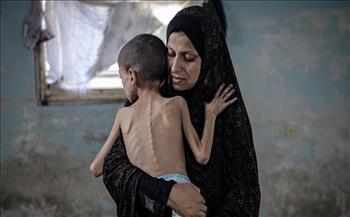 وزارة الصحة بغزة: 13 شهيدا بينهم 3 أطفال بسبب المجاعة وسوء التغذية خلال 24 ساعة