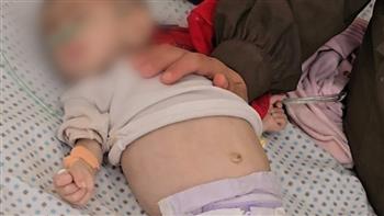 وفاة طفلة بسبب المجاعة في غزة.. ومستوطنون يقتحمون باحات الأقصى بحماية شرطة الاحتلال
