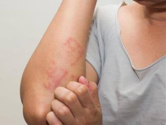 ماذا تعرف عن الهربس النطاقى الأذنى