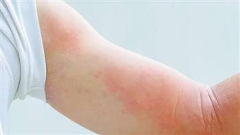 طرق‭ ‬النجاة‭ ‬من‭ ‬لدغات‭ ‬أرتكاريا‭ ‬البرد‭!‬