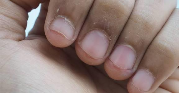 خطوات‭ ‬بسيطة‭ ‬للحماية‭ ‬من‭ ‬تقصف‭ ‬الأظافر‭ ‬فى‭ ‬الشتاء‭ ‬