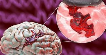 انتبه لأسباب الجلطة الدماغية