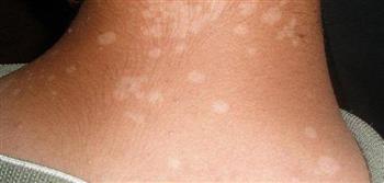 انتبه..لأعراض التينيا