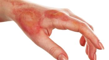 طرق التعامل الصحيح مع الحروق البسيطة