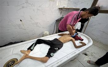 الأمم المتحدة: ارتفاع حالات سوء التغذية الحاد في غزة إلى 95 ألف حالة