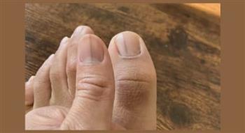 الخطوط السوداء على الظفر.. متى تكون علامة عابرة ومتى تستدعي الفحص الطبي؟