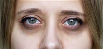 ما العلاقة بين الكبد والهالات أسفل العينين؟.. أطباء يوضحون