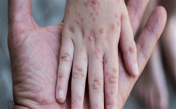 الكاميرون ترفع مستوى التأهب الصحي بسبب تفشي جدري القرود