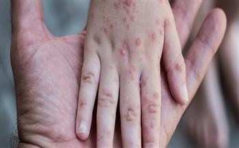 الكاميرون ترفع مستوى التأهب الصحي بسبب تفشي جدري القرود