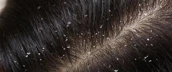 ما الفرق بين قشرة الشعر الجافة والدهنية