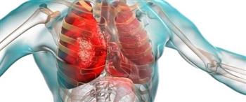 الالتهاب الرئوي..ماهى أعراضه ؟