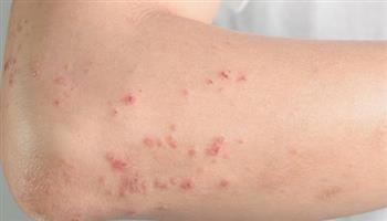 بهذه الطرق يمكن الوقاية من حساسية الصرصور