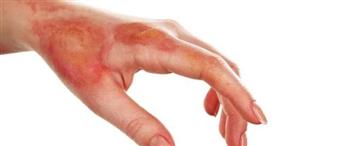 مضاعفات الحروق الحرارية