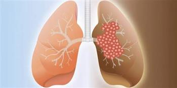 أعراض مرض التليف الرئوي