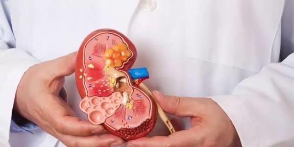 هذه هي العلامات المبكرة لمشاكل الكلى