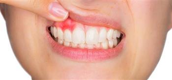 كيف ينتقل تأثير أمراض اللثة إلى القلب؟