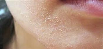 للنساء.. أسباب تقشير الجلد رغم ترطيبه في الشتاء