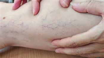 4  مضاعفات لدوالي الساقين