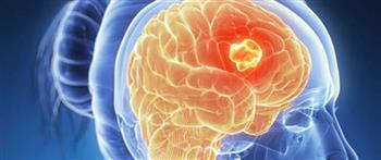 احذر.. أعراض تشير لسرطان المخ