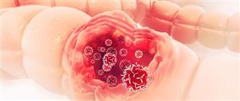 انتبه ..تلك أهم مؤشرات الإصابة بسرطان الأمعاء