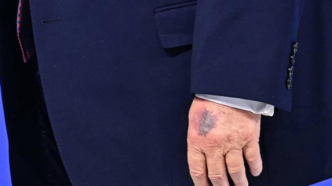 يد ترامب ما لها؟!.. العلامة «الأرجوانية-الزرقاء» تشعل التكهنات