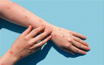 المركز الأفريقي لمكافحة الأمراض يرفع حالة الطوارئ المرتبطة بجدري القرود