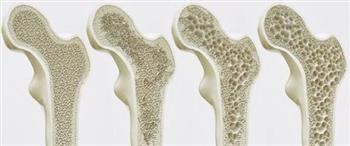 الدكتور‭ ‬إبراهيم‭ ‬جادو‭ :‬احترسوا‭ ‬من‭ ‬‮«‬اللص‭ ‬الصامت‮»‬‭... ‬الشهير‭ ‬بـــــ«هشاشة‭ ‬العظام‮»‬‭! 