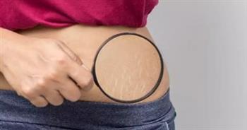 كيف تؤثر تغذيتك على" الاسترتش ماركس" بعد الولادة؟