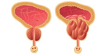 مع تقدم العمر..كيف تتعامل مع تضخم البروستاتا الحميد؟