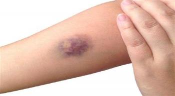 انخفاض الصفائح الدموية.. اكتشف أسبابه؟