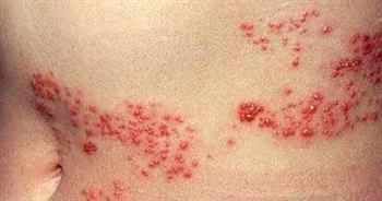 احذر ..هذه الأطعمة تزيد من أعراض الحزام الناري