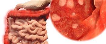 5 مضاعفات لالتهاب القولون التقرّحي