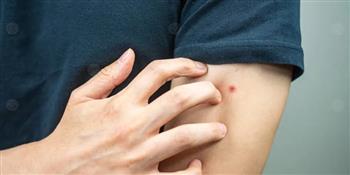 احذر لدغات الحشرات سببًا في الأرق ليلًا