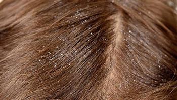 لماذا تزداد قشرة الشعر في الشتاء ؟