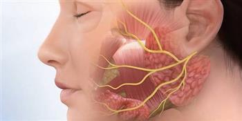 تعرف علي أعراض الإصابة بالتهاب العصب الوجهي