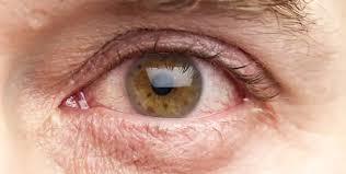 لماذا يحدث جفاف العين ؟