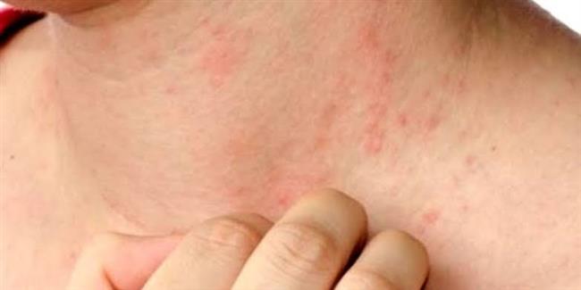 انتبه التوتر قد يسبب الطفح الجلدي