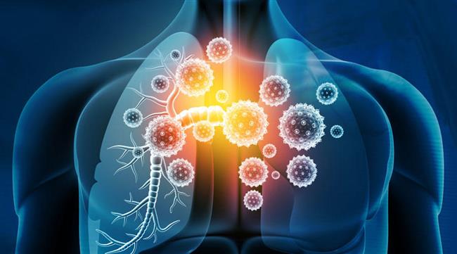 أعراض التهاب الشعب الهوائية المصاحب للتدخين 