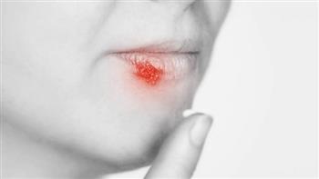 أسباب إصابتك بالهربس وطرق طبيعية للشفاء منه