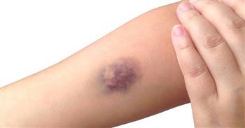 أسباب ظهور كدمات زرقاء أو حمراء في الجسم